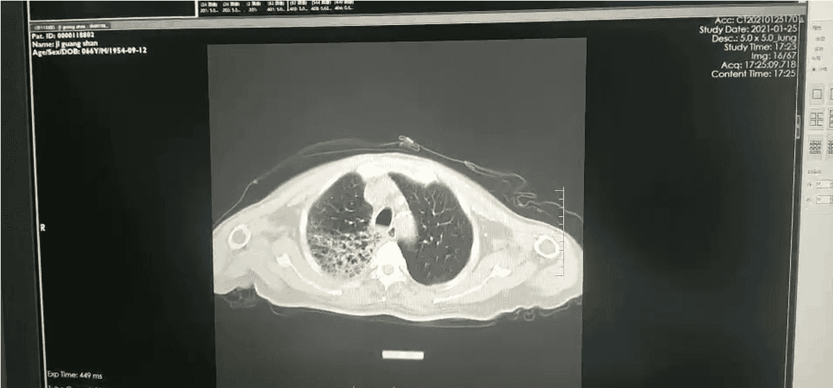 【无症状感染肺炎病例/无症状感染肺炎需要治疗吗】