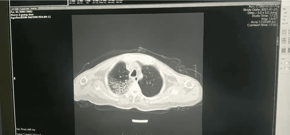 【无症状感染肺炎病例/无症状感染肺炎需要治疗吗】
