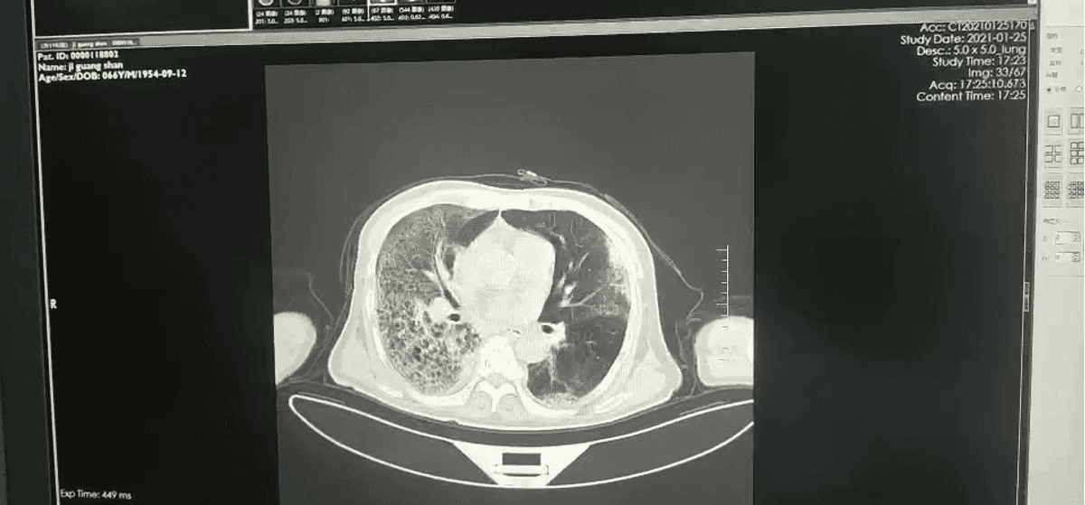 【无症状感染肺炎病例/无症状感染肺炎需要治疗吗】