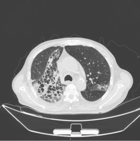 【无症状感染肺炎病例/无症状感染肺炎需要治疗吗】