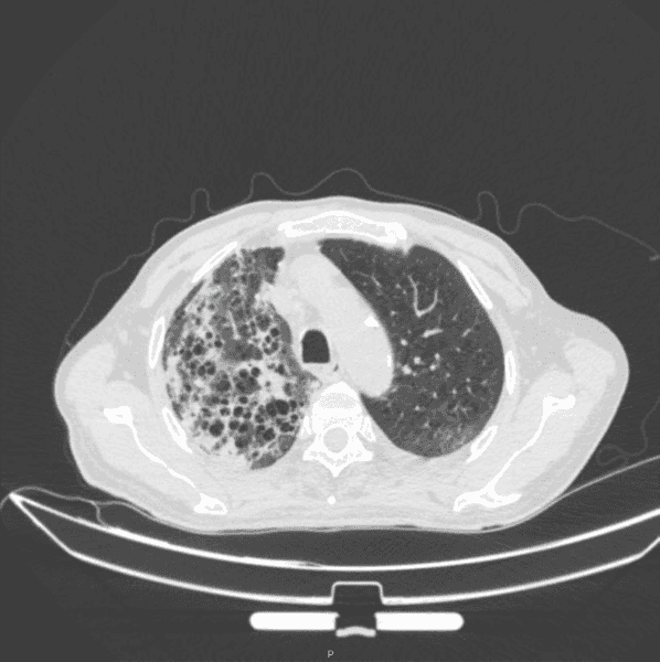 【无症状感染肺炎病例/无症状感染肺炎需要治疗吗】