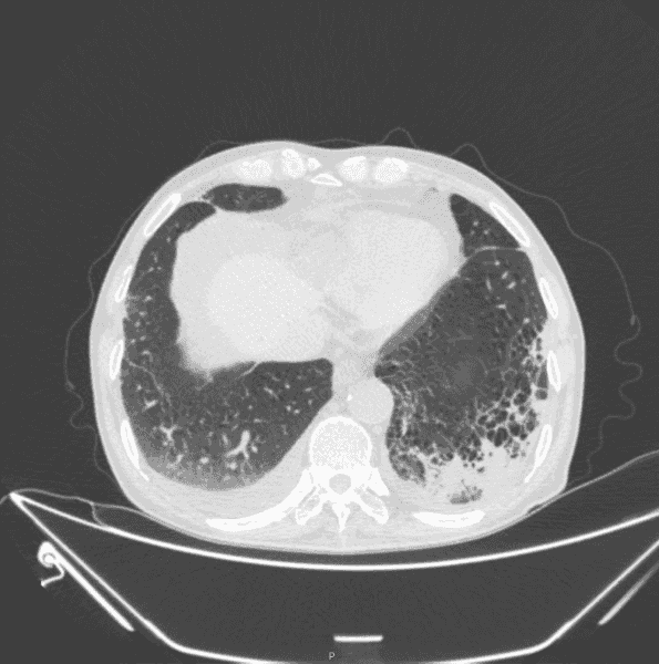 【无症状感染肺炎病例/无症状感染肺炎需要治疗吗】