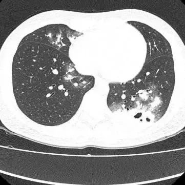 广州最新无症状感染:广州无症状感染者公布